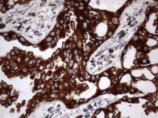 Acidic Cytokeratin Antibody - IHC of paraffin-embedded Carcinoma of Human lung tissue using anti-Acidic CK rat monoclonal antibody.