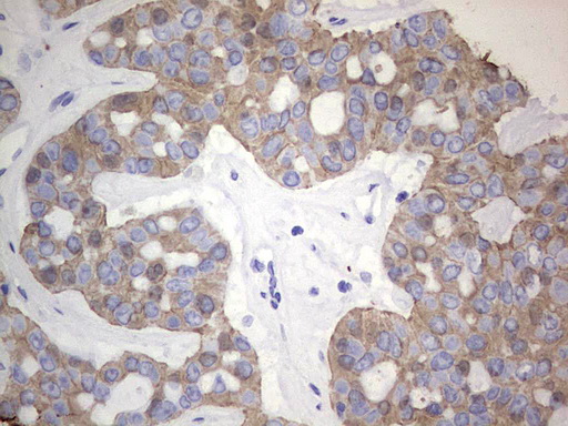 Acidic Cytokeratin Antibody - IHC of paraffin-embedded Carcinoma of Human liver tissue using anti-Acidic CK rat monoclonal antibody.