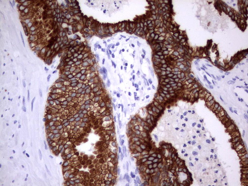 Acidic Cytokeratin Antibody - IHC of paraffin-embedded Carcinoma of Human prostate tissue using anti-Acidic CK rat monoclonal antibody.