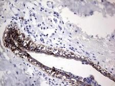 Acidic Cytokeratin Antibody - IHC of paraffin-embedded Adenocarcinoma of Human breast tissue using anti-Acidic CK rat monoclonal antibody.
