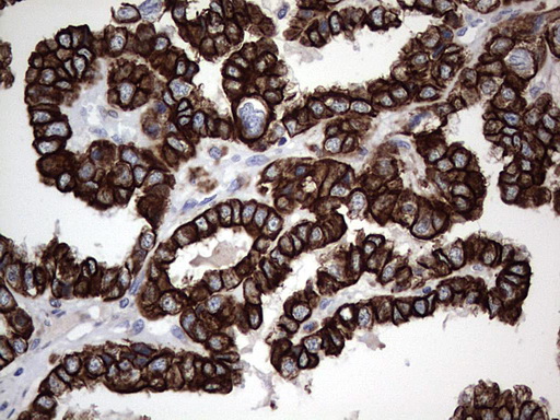 Acidic Cytokeratin Antibody - IHC of paraffin-embedded Adenocarcinoma of Human ovary tissue using anti-Acidic CK rat monoclonal antibody.