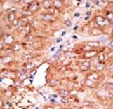 ACKR2 / CCR10 / D6 Antibody - Formalin-fixed and paraffin-embedded human cancer tissue reacted with the primary antibody, which was peroxidase-conjugated to the secondary antibody, followed by AEC staining. This data demonstrates the use of this antibody for immunohistochemistry; clinical relevance has not been evaluated. BC = breast carcinoma; HC = hepatocarcinoma.