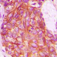 ACKR3 / CXCR7 Antibody - Immunohistochemical analysis of GPR159 staining in human breast cancer formalin fixed paraffin embedded tissue section. The section was pre-treated using heat mediated antigen retrieval with sodium citrate buffer (pH 6.0). The section was then incubated with the antibody at room temperature and detected using an HRP conjugated compact polymer system. DAB was used as the chromogen. The section was then counterstained with hematoxylin and mounted with DPX.