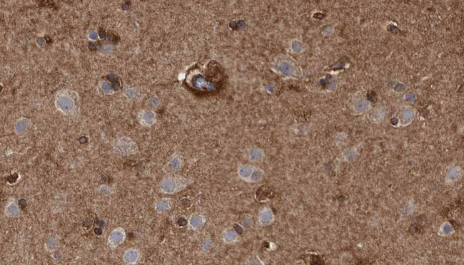 ACKR3 / CXCR7 Antibody - 1:100 staining human brain carcinoma tissue by IHC-P. The sample was formaldehyde fixed and a heat mediated antigen retrieval step in citrate buffer was performed. The sample was then blocked and incubated with the antibody for 1.5 hours at 22°C. An HRP conjugated goat anti-rabbit antibody was used as the secondary.