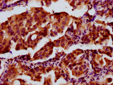 ACLP / AEBP1 Antibody - Immunohistochemistry Dilution at 1:300 and staining in paraffin-embedded human lung cancer performed on a Leica BondTM system. After dewaxing and hydration, antigen retrieval was mediated by high pressure in a citrate buffer (pH 6.0). Section was blocked with 10% normal Goat serum 30min at RT. Then primary antibody (1% BSA) was incubated at 4°C overnight. The primary is detected by a biotinylated Secondary antibody and visualized using an HRP conjugated SP system.