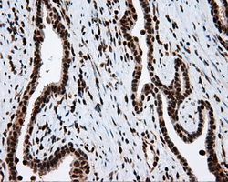 ACLY / ATP Citrate Lyase Antibody - IHC of paraffin-embedded Carcinoma of prostate tissue using anti-ACLY mouse monoclonal antibody. (Dilution 1:50).