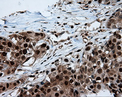ACLY / ATP Citrate Lyase Antibody - IHC of paraffin-embedded Adenocarcinoma of breast tissue using anti-ACLY mouse monoclonal antibody. (Dilution 1:50).