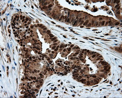 ACLY / ATP Citrate Lyase Antibody - IHC of paraffin-embedded Adenocarcinoma of colon tissue using anti-ACLY mouse monoclonal antibody. (Dilution 1:50).