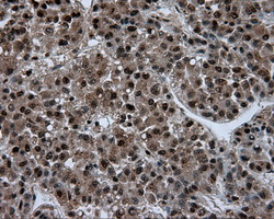 ACLY / ATP Citrate Lyase Antibody - IHC of paraffin-embedded Carcinoma of liver tissue using anti-ACLY mouse monoclonal antibody. (Dilution 1:50).