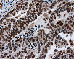 ACLY / ATP Citrate Lyase Antibody - IHC of paraffin-embedded Adenocarcinoma of ovary tissue using anti-ACLY mouse monoclonal antibody. (Dilution 1:50).