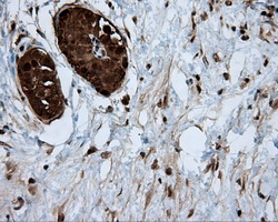ACLY / ATP Citrate Lyase Antibody - IHC of paraffin-embedded Carcinoma of pancreas tissue using anti-ACLY mouse monoclonal antibody. (Dilution 1:50).