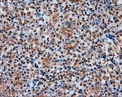 ACLY / ATP Citrate Lyase Antibody - IHC of paraffin-embedded Carcinoma of thyroid tissue using anti-ACLY mouse monoclonal antibody. (Dilution 1:50).