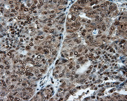 ACLY / ATP Citrate Lyase Antibody - IHC of paraffin-embedded Adenocarcinoma of endometrium tissue using anti-ACLY mouse monoclonal antibody. (Dilution 1:50).