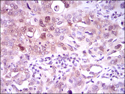 ACLY / ATP Citrate Lyase Antibody - IHC of paraffin-embedded endometrial cancer tissues using ACLY mouse monoclonal antibody with DAB staining.