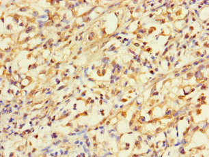 ACLY / ATP Citrate Lyase Antibody - Immunohistochemistry of paraffin-embedded human gastric cancer using ACLY Antibody at dilution of 1:100