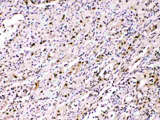 ACLY / ATP Citrate Lyase Antibody - ATP citrate lyase was detected in paraffin-embedded sections of human intestinal cancer tissues using rabbit anti- ATP citrate lyase Antigen Affinity purified polyclonal antibody
