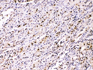 ACLY / ATP Citrate Lyase Antibody - IHC testing of FFPE human intestinal cancer tissue with ATP Citrate Lyase antibody at 1ug/ml. HIER: steam sections in pH6 citrate buffer for 20 min.