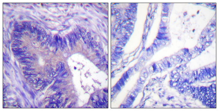 ACLY / ATP Citrate Lyase Antibody - Immunohistochemistry analysis of paraffin-embedded human colon carcinoma, using ATP-Citrate Lyase (Phospho-Ser454) Antibody. The picture on the right is blocked with the phospho peptide.