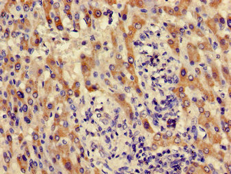 ACMSD Antibody - Immunohistochemistry image of paraffin-embedded human liver cancer at a dilution of 1:100
