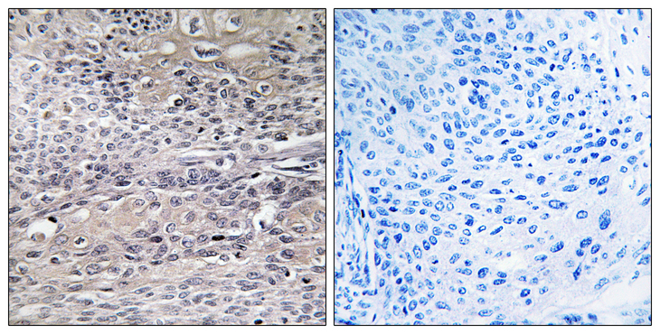 ACO1 / Aconitase Antibody - Immunohistochemistry analysis of paraffin-embedded human thyroid gland tissue, using IREB1 Antibody. The picture on the right is blocked with the synthesized peptide.