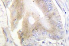 ACO1 / Aconitase Antibody - IHC of IRP-1 (R134) pAb in paraffin-embedded human colon carcinoma tissue.