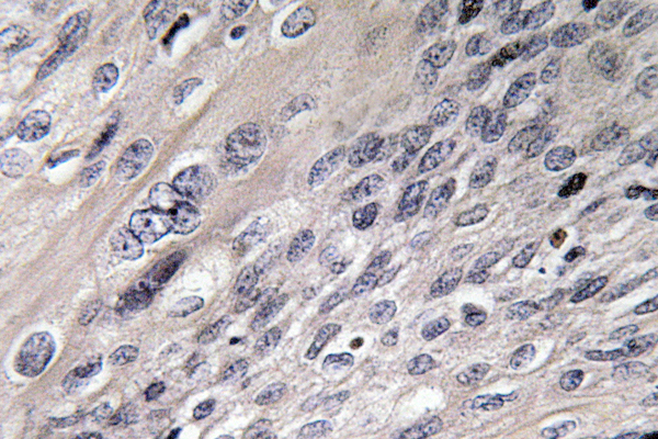 ACO1 / Aconitase Antibody - IHC of IRP-1 (N707) pAb in paraffin-embedded human cervix carcinoma tissue.
