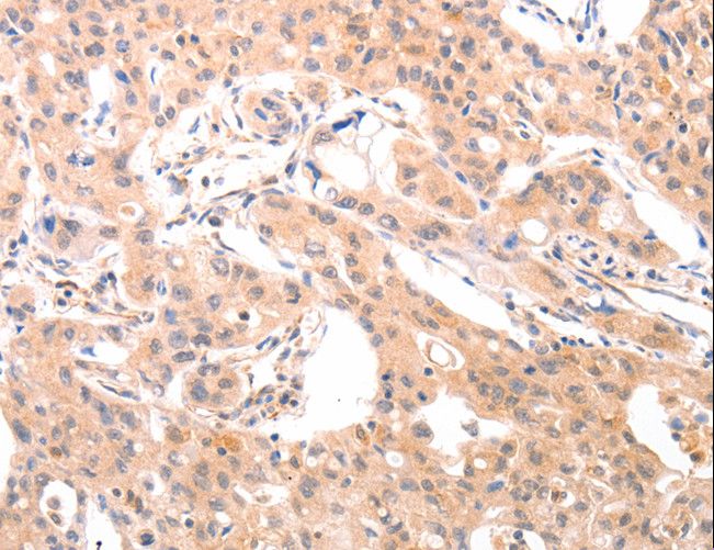 ACO1 / Aconitase Antibody - Immunohistochemistry of paraffin-embedded Human lung cancer using ACO1 Polyclonal Antibody at dilution of 1:50.