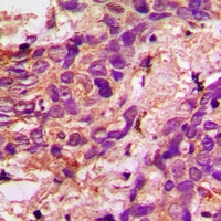 ACO1 / Aconitase Antibody - Immunohistochemical analysis of Aconitase 1 staining in human prostate cancer formalin fixed paraffin embedded tissue section. The section was pre-treated using heat mediated antigen retrieval with sodium citrate buffer (pH 6.0). The section was then incubated with the antibody at room temperature and detected with HRP and DAB as chromogen. The section was then counterstained with hematoxylin and mounted with DPX.