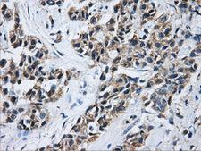 ACO2 / Aconitase 2 Antibody - IHC of paraffin-embedded Adenocarcinoma of breast tissue using anti-ACO2 mouse monoclonal antibody. (Dilution 1:50).