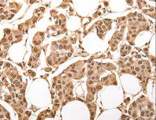 ACO2 / Aconitase 2 Antibody - Immunohistochemistry of paraffin-embedded Human breast cancer using ACO2 Polyclonal Antibody at dilution of 1:30.