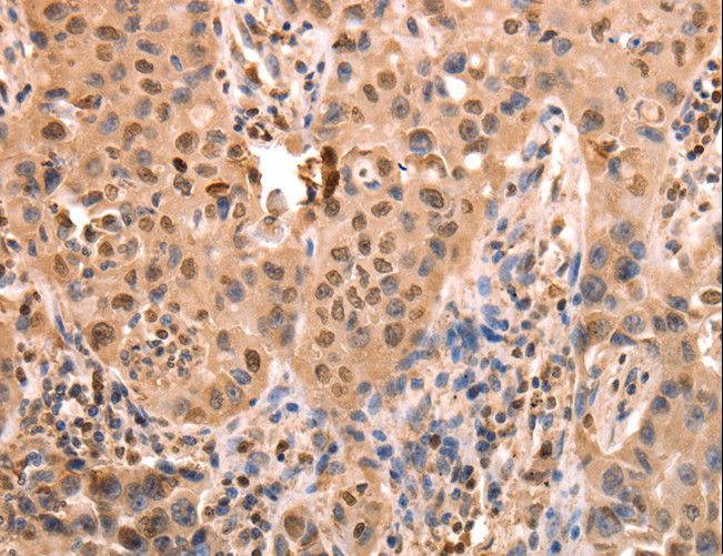 ACO2 / Aconitase 2 Antibody - Immunohistochemistry of paraffin-embedded Human lung cancer using ACO2 Polyclonal Antibody at dilution of 1:30.