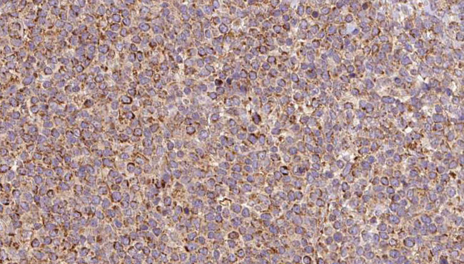 ACO2 / Aconitase 2 Antibody - 1:100 staining human lymph carcinoma tissue by IHC-P. The sample was formaldehyde fixed and a heat mediated antigen retrieval step in citrate buffer was performed. The sample was then blocked and incubated with the antibody for 1.5 hours at 22°C. An HRP conjugated goat anti-rabbit antibody was used as the secondary.