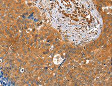 ACOT11 / THEA Antibody - Immunohistochemistry of paraffin-embedded Human cervical cancer using ACOT11 Polyclonal Antibody at dilution of 1:25.