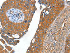 ACOT11 / THEA Antibody - Immunohistochemistry of paraffin-embedded Human cervical cancer using ACOT11 Polyclonal Antibody at dilution of 1:40.