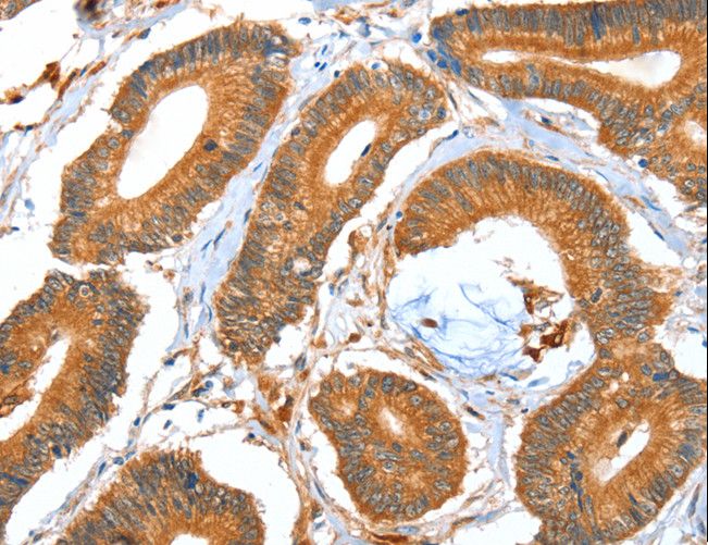 ACOT11 / THEA Antibody - Immunohistochemistry of paraffin-embedded Human colon cancer using ACOT11 Polyclonal Antibody at dilution of 1:40.