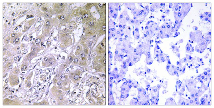 ACOT12 Antibody - Immunohistochemistry analysis of paraffin-embedded human liver carcinoma tissue, using ACOT12 Antibody. The picture on the right is blocked with the synthesized peptide.