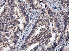 ACOT12 Antibody - IHC of paraffin-embedded Carcinoma of Human lung tissue using anti-ACOT12 mouse monoclonal antibody.