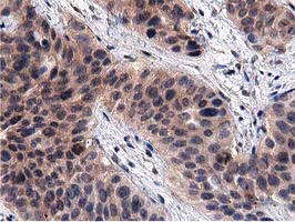 ACOT12 Antibody - IHC of paraffin-embedded Carcinoma of Human bladder tissue using anti-ACOT12 mouse monoclonal antibody.