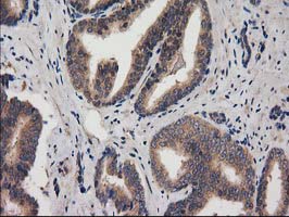 ACOT12 Antibody - IHC of paraffin-embedded Carcinoma of Human prostate tissue using anti-ACOT12 mouse monoclonal antibody.