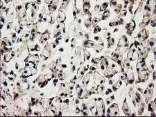 ACOT12 Antibody - IHC of paraffin-embedded Adenocarcinoma of Human colon tissue using anti-ACOT12 mouse monoclonal antibody.