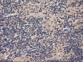 ACOT12 Antibody - IHC of paraffin-embedded Human lymphoma tissue using anti-ACOT12 mouse monoclonal antibody.