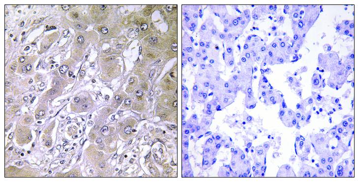 ACOT12 Antibody - Peptide - + Immunohistochemistry analysis of paraffin-embedded human liver carcinoma tissue using ACOT12 antibody.