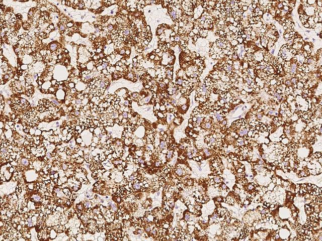 ACOT13 / THEM2 Antibody - Immunochemical staining of human THEM2 in human hepatoma with rabbit polyclonal antibody at 1:1000 dilution, formalin-fixed paraffin embedded sections.