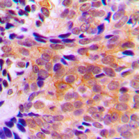 ACOT2 Antibody - Immunohistochemical analysis of ACOT2 staining in human breast cancer formalin fixed paraffin embedded tissue section. The section was pre-treated using heat mediated antigen retrieval with sodium citrate buffer (pH 6.0). The section was then incubated with the antibody at room temperature and detected using an HRP conjugated compact polymer system. DAB was used as the chromogen. The section was then counterstained with hematoxylin and mounted with DPX.