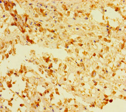ACOT6 Antibody - Immunohistochemistry of paraffin-embedded human melanoma using ACOT6 Antibody at dilution of 1:100