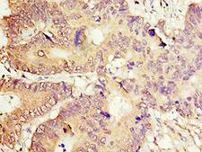 ACOT7 / BACH Antibody - Immunohistochemistry of paraffin-embedded human colon cancer using antibody at 1:100 dilution.