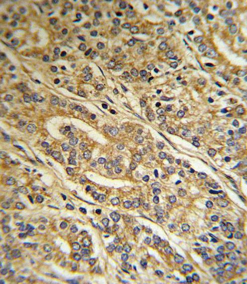 ACOT8 Antibody - Formalin-fixed and paraffin-embedded human Prostate carcinoma reacted with ACOT8 Antibody , which was peroxidase-conjugated to the secondary antibody, followed by DAB staining. This data demonstrates the use of this antibody for immunohistochemistry; clinical relevance has not been evaluated.