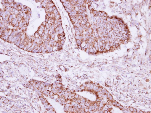 ACOT9 Antibody - IHC of paraffin-embedded Colon ca, using ACOT9 antibody at 1:250 dilution.