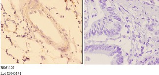 ACOT9 Antibody - Immunohistochemistry (IHC) analysis of ACOT9 antibody in paraffin-embedded human colon carcinoma tissue at 1:50, showing cytoplasmic staining. Negative control (the right) using PBS instead of primary antibody. Secondary antibody is Goat Anti-Rabbit IgG-biotin.