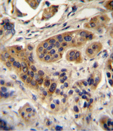 ACOX1 / ACOX Antibody - ACOX1 Antibody immunohistochemistry of formalin-fixed and paraffin-embedded human bladder carcinoma followed by peroxidase-conjugated secondary antibody and DAB staining.